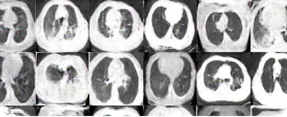 covid-19 胸部ct图像增强gan数据集