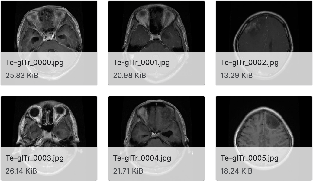 脑肿瘤 mri 数据集